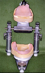 症例２ 下顎左側歯肉癌切除した義歯