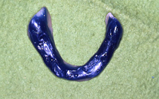 症例２ 下顎左側歯肉癌切除した義歯